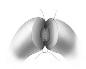 Vasectomy Reversal Picture 2B